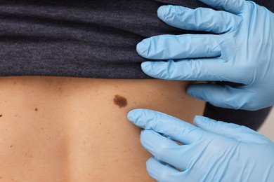 Photo of Dermatologist in rubber gloves examining patient's birthmark, closeup view