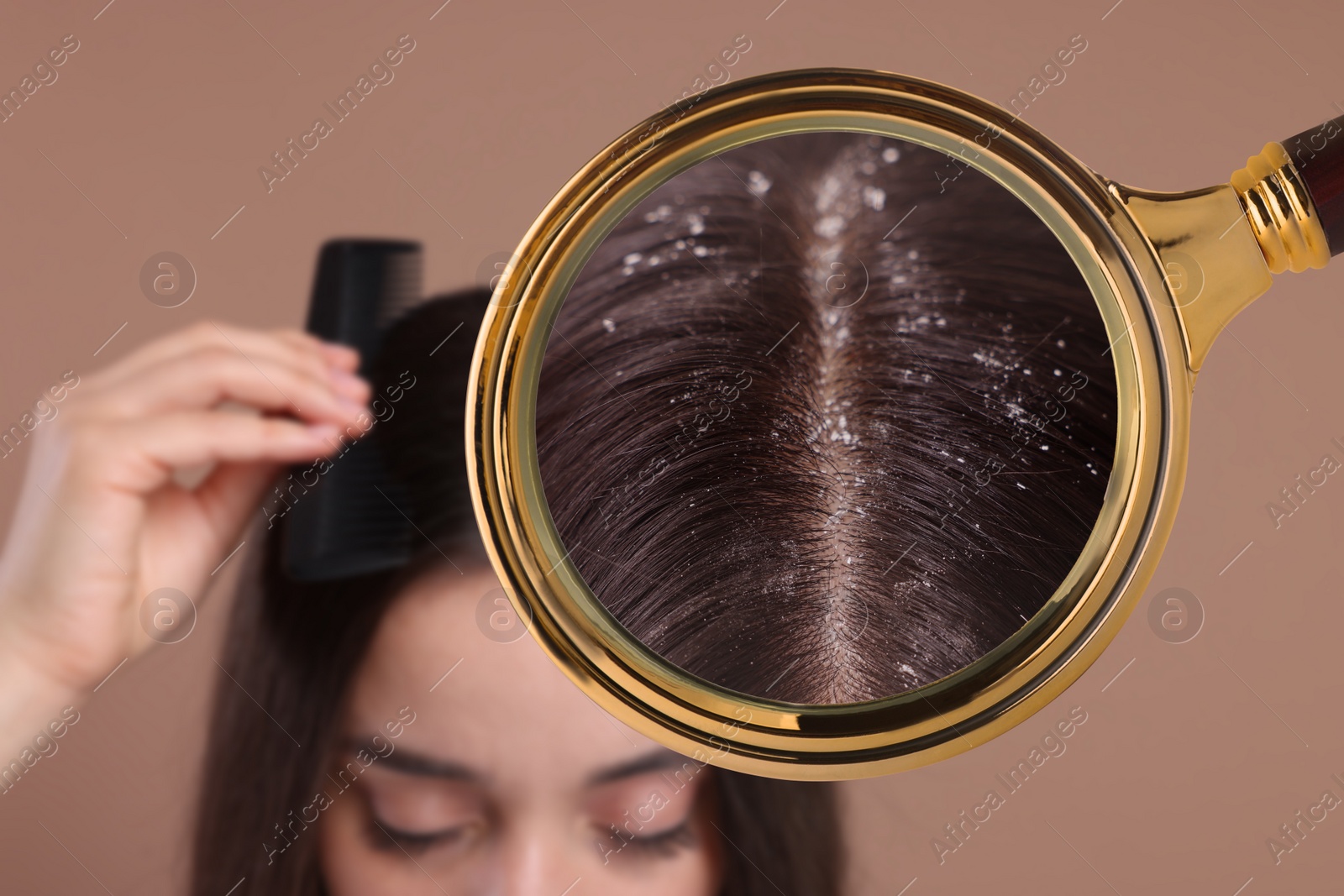 Image of Woman suffering from dandruff on pale brown background, closeup. View through magnifying glass on hair with flakes