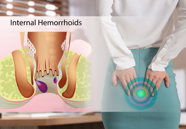 Image of Young woman suffering from hemorrhoid pain in office, closeup. Illustration of unhealthy lower rectum