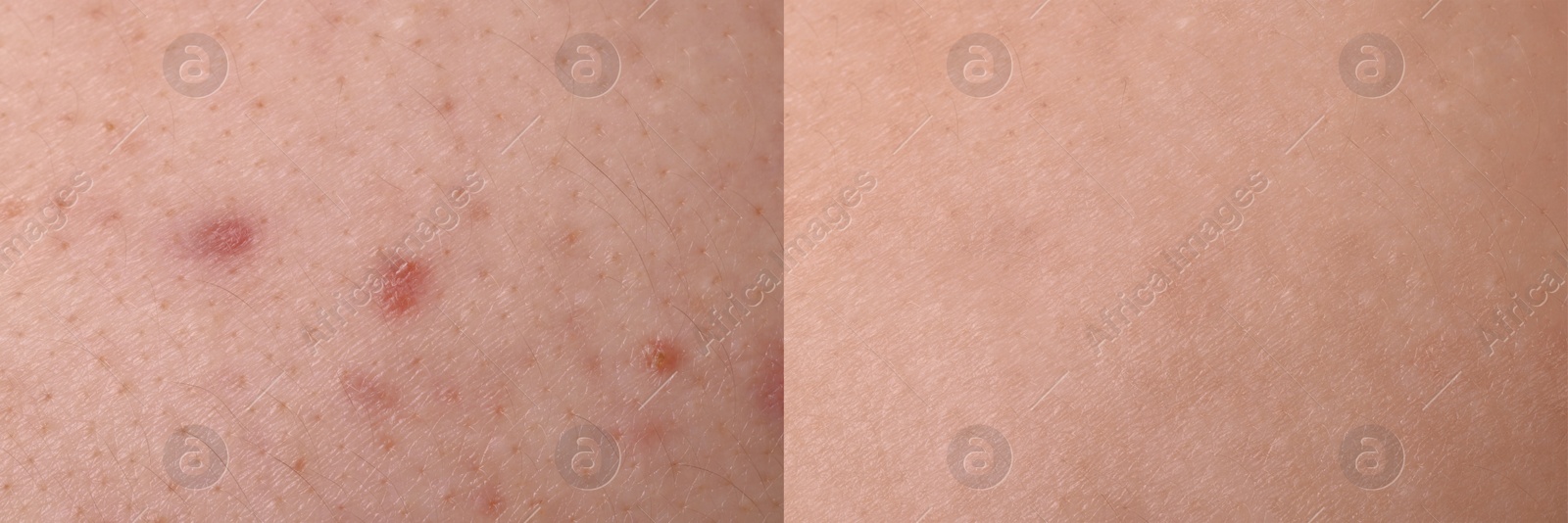 Image of Collage with photos of person suffering from acne before and after treatment, closeup. Banner design showing affected and healthy skin