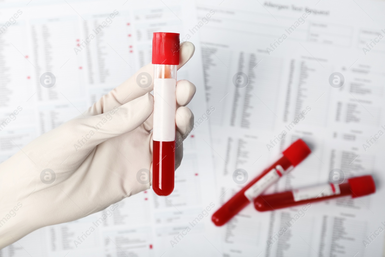 Photo of Doctor holding glass tube with blood sample over table, closeup. Allergy test