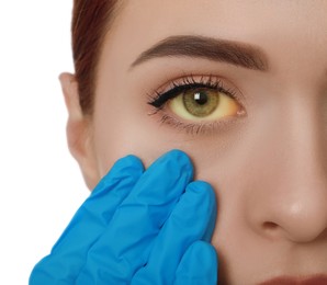 Photo of Doctor checking woman with yellow eyes on white background, closeup. Symptom of hepatitis