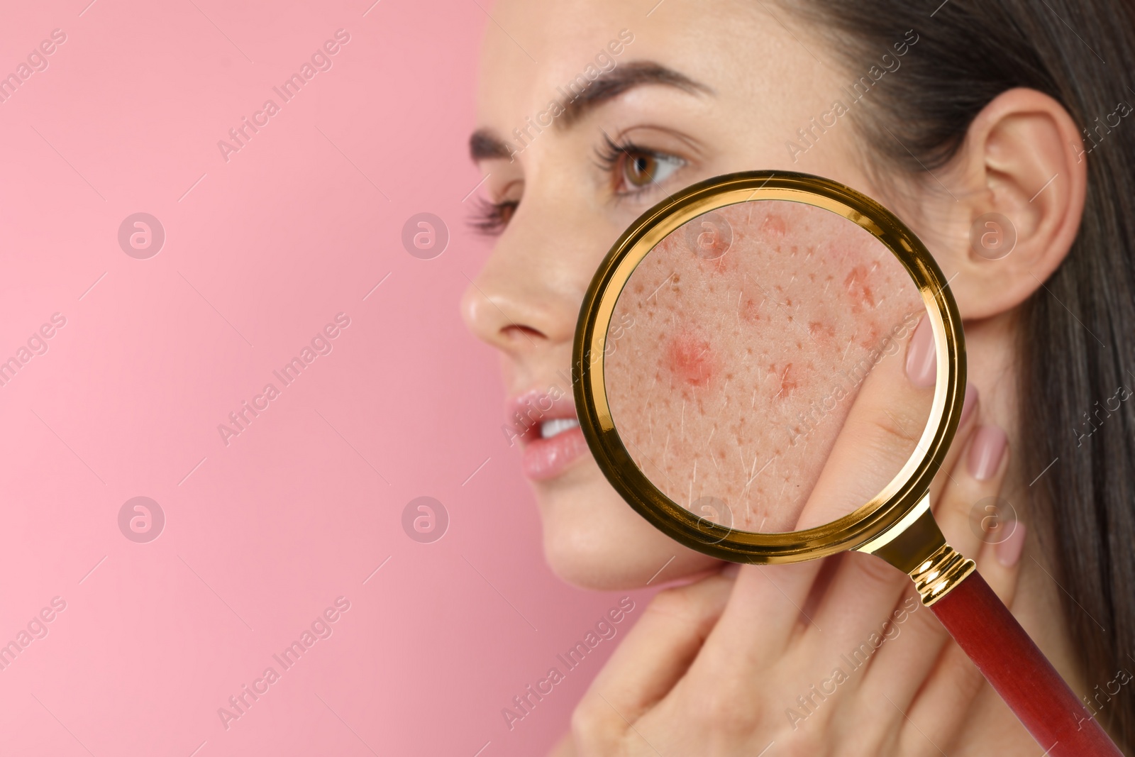 Image of Dermatology. Woman with skin problem on pink background. View through magnifying glass on acne