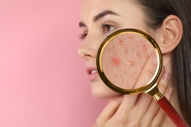 Dermatology. Woman with skin problem on pink background. View through magnifying glass on acne
