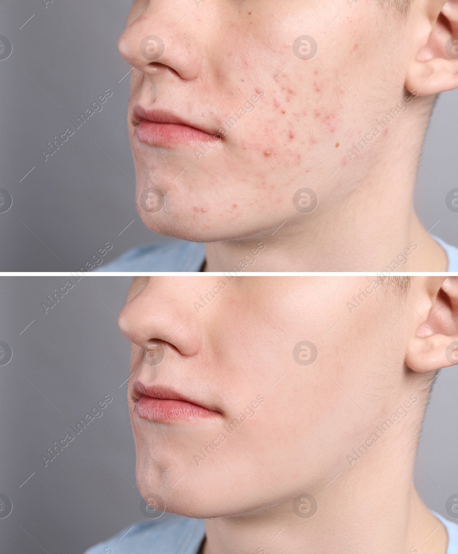 Image of Acne problem. Young man before and after treatment on grey background, closeup. Collage of photos