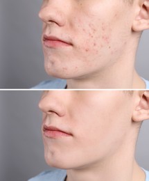 Acne problem. Young man before and after treatment on grey background, closeup. Collage of photos