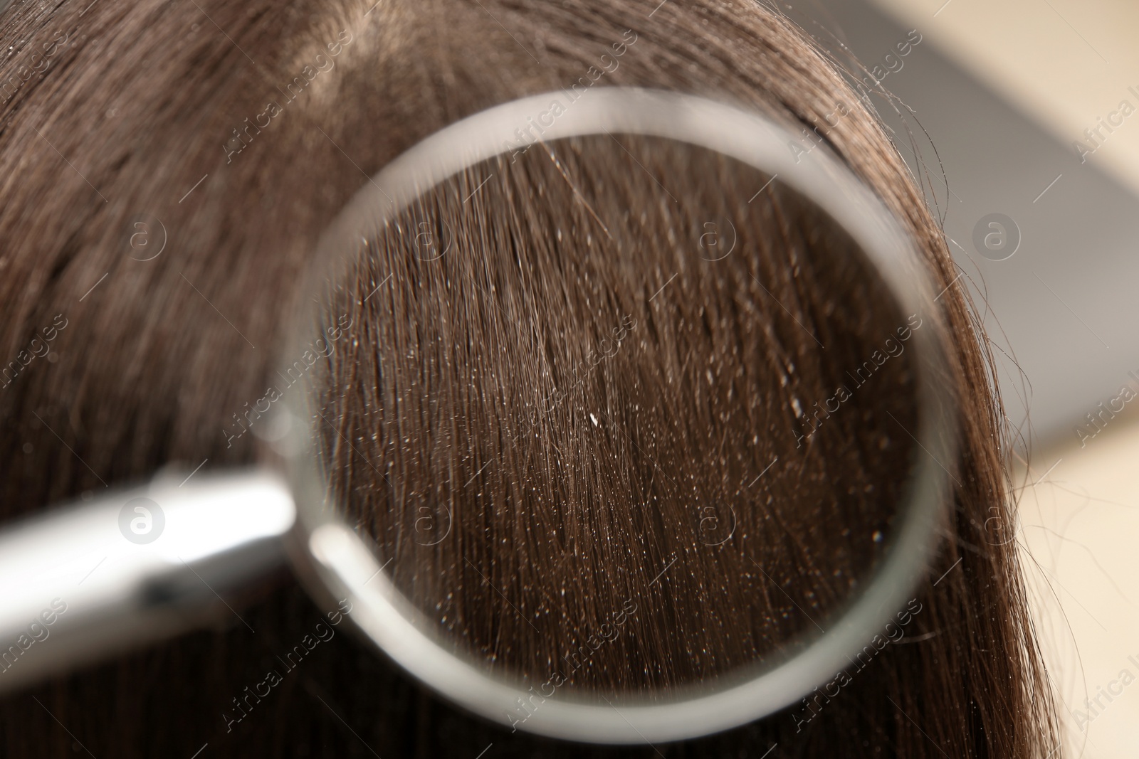 Photo of Closeup of woman with dandruff in her hair, view through magnifying glass