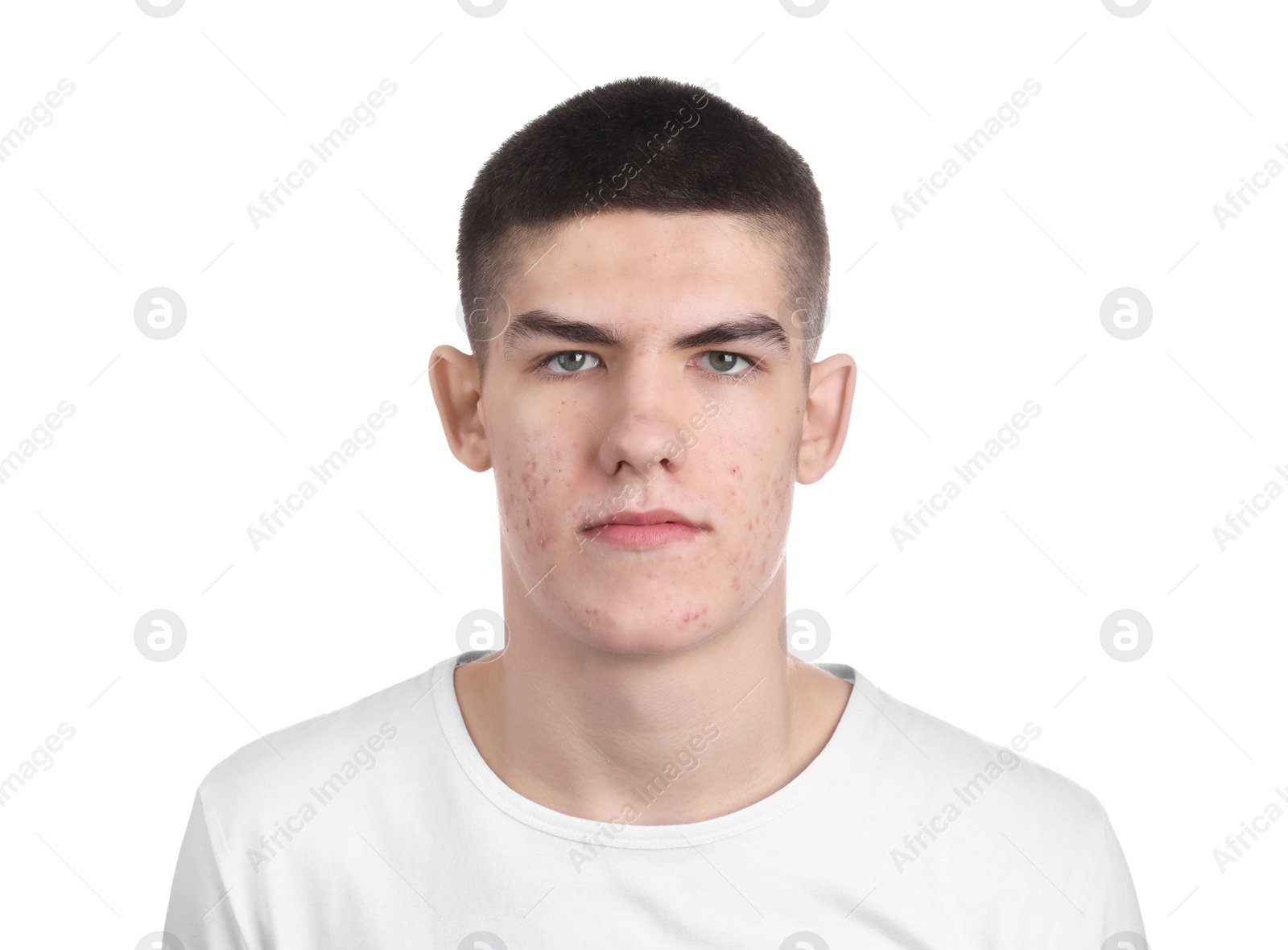 Photo of Young man with acne problem isolated on white