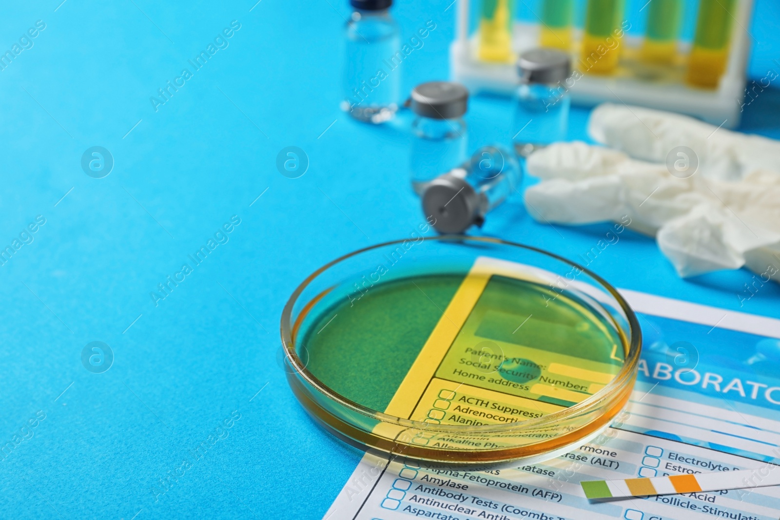 Photo of Glass dish with urine sample and test form on table. Urology concept