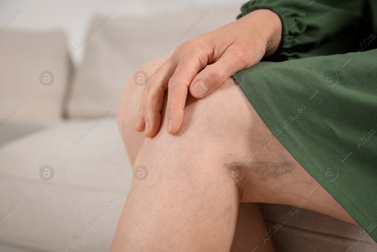 Photo of Woman with varicose veins on sofa in room, closeup