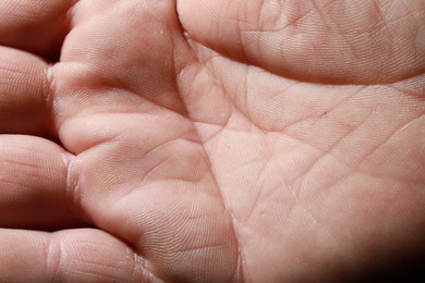 Photo of Closeup view of human hand with dry skin