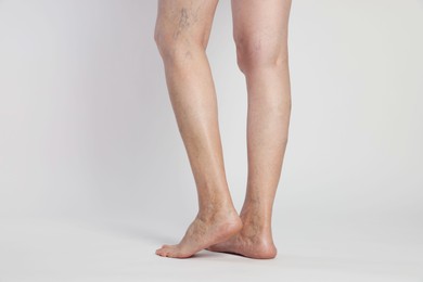 Closeup view of woman with varicose veins on light background