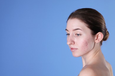 Photo of Young woman with acne problem on blue background. Space for text