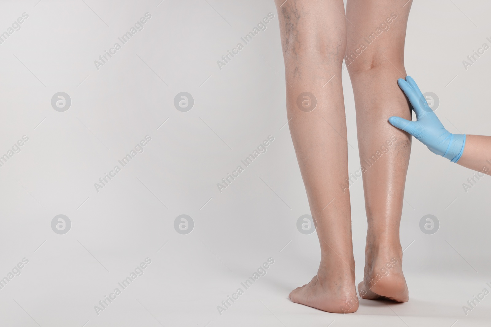Photo of Doctor examining patient with varicose veins on light background, closeup. Space for text