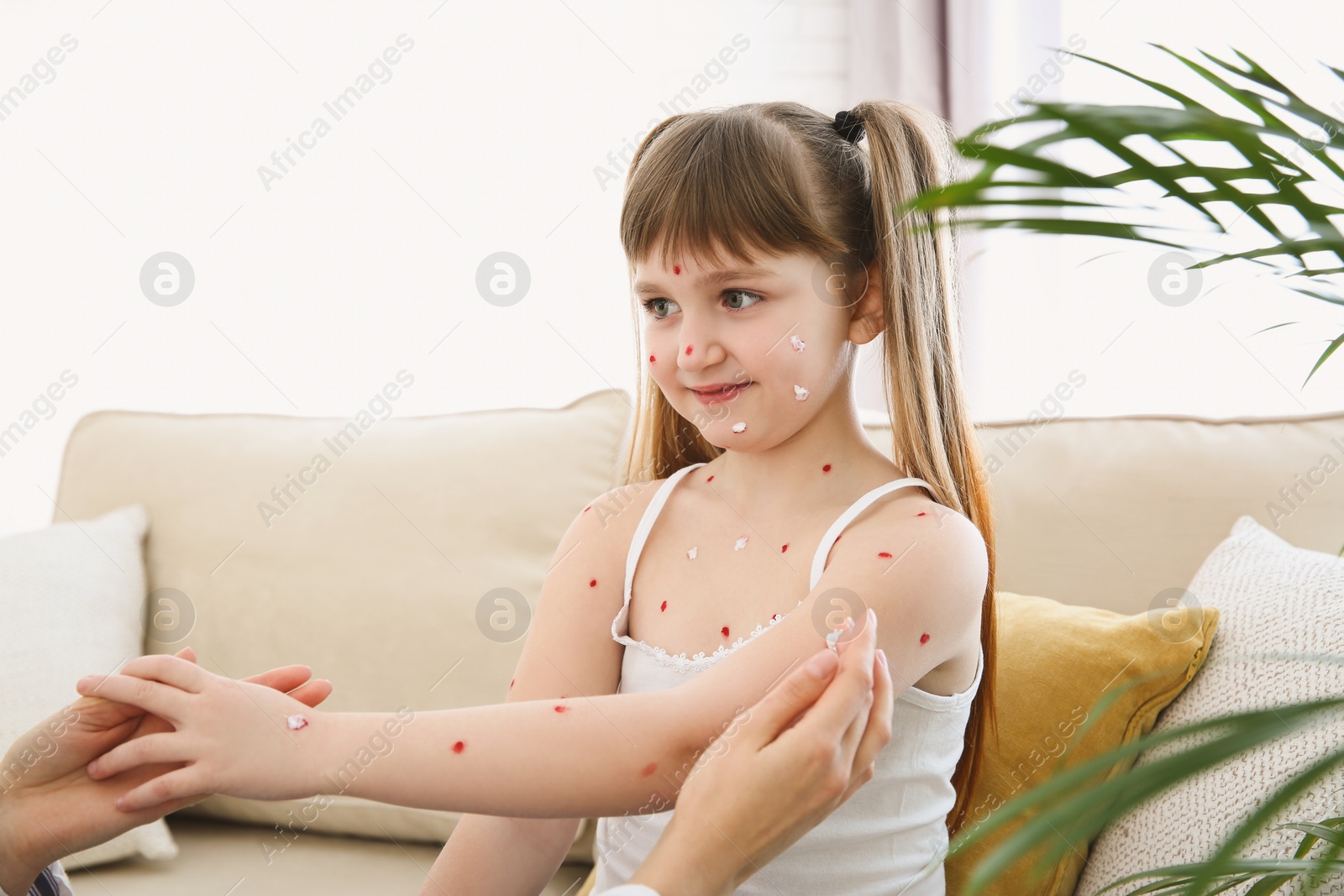 Photo of Woman applying cream onto skin of little girl with chickenpox at home