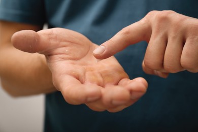 Photo of Man applying cream on hand for calluses treatment against grey background, closeup