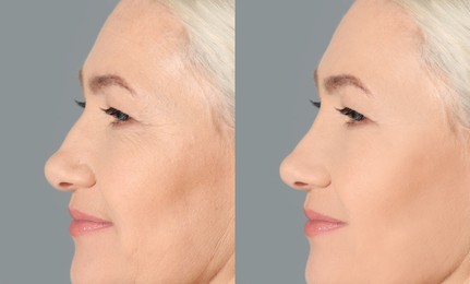 Collage with photos of mature woman before and after biorevitalization procedure on grey background 