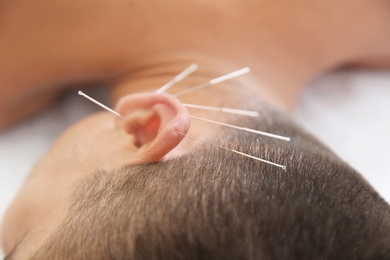 Photo of Young man undergoing acupuncture treatment in salon, closeup