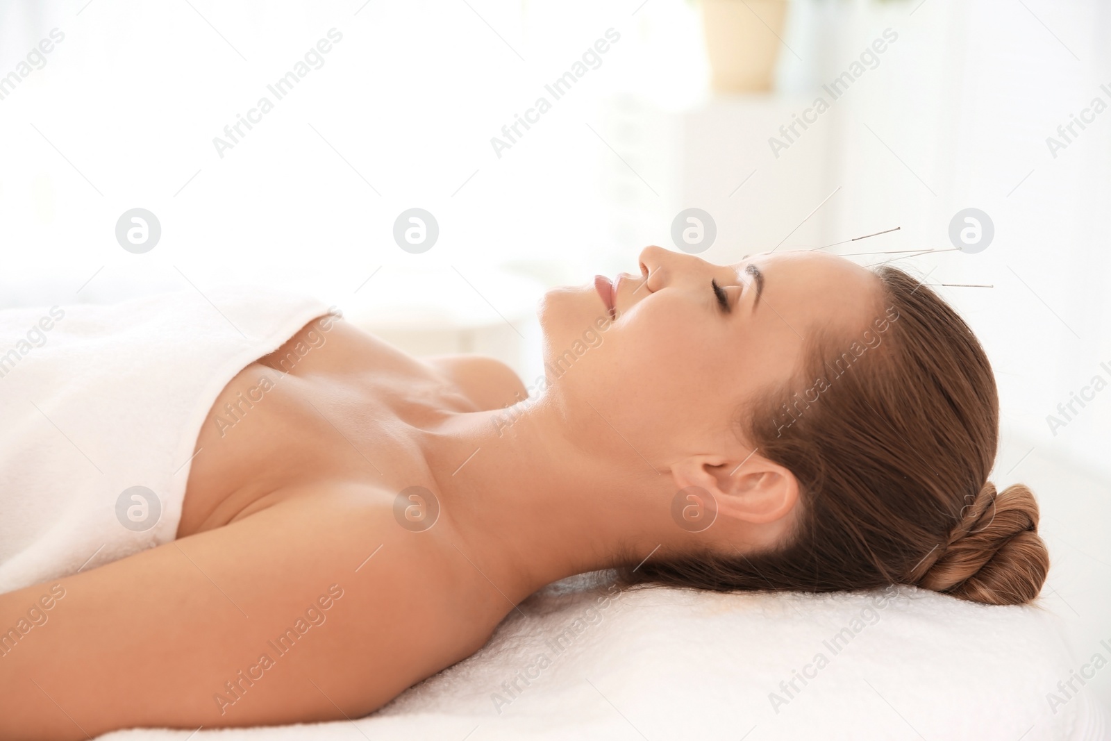 Photo of Young woman undergoing acupuncture treatment in salon