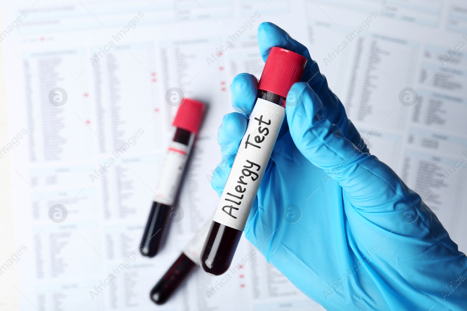 Photo of Doctor holding glass tube with blood over table, top view. Allergy test