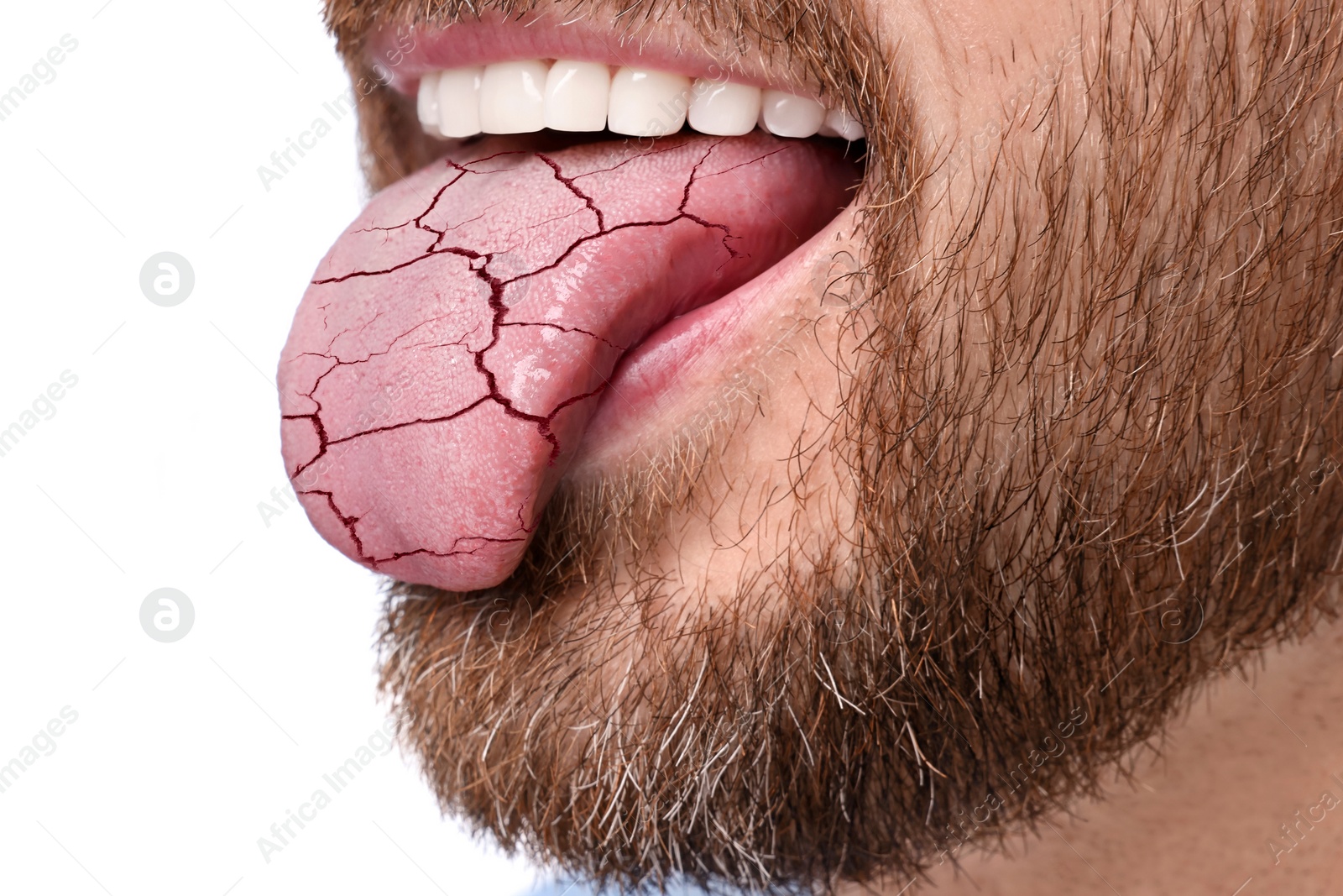 Image of Dry mouth symptom. Man showing dehydrated tongue on white background, closeup