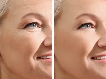 Collage with photos of mature woman before and after biorevitalization procedure, closeup