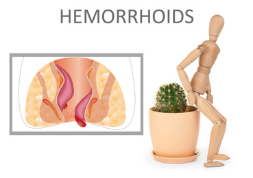 Hemorrhoids. Wooden human figure near cactus and illustration of unhealthy lower rectum on white background