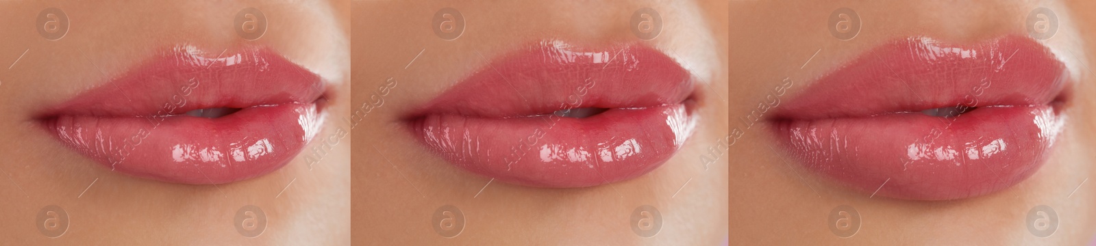 Image of Lip correction procedure stages, banner design. Woman with beautiful lips, closeup