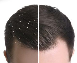Image of Collage showing man's hair before and after lice treatment on white background, closeup. Suffering from pediculosis