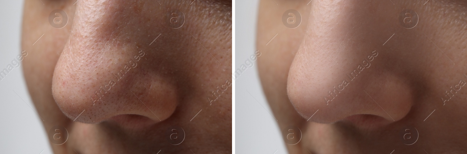 Image of Before and after acne treatment. Photos of woman on white background, closeup. Collage showing affected and healthy skin