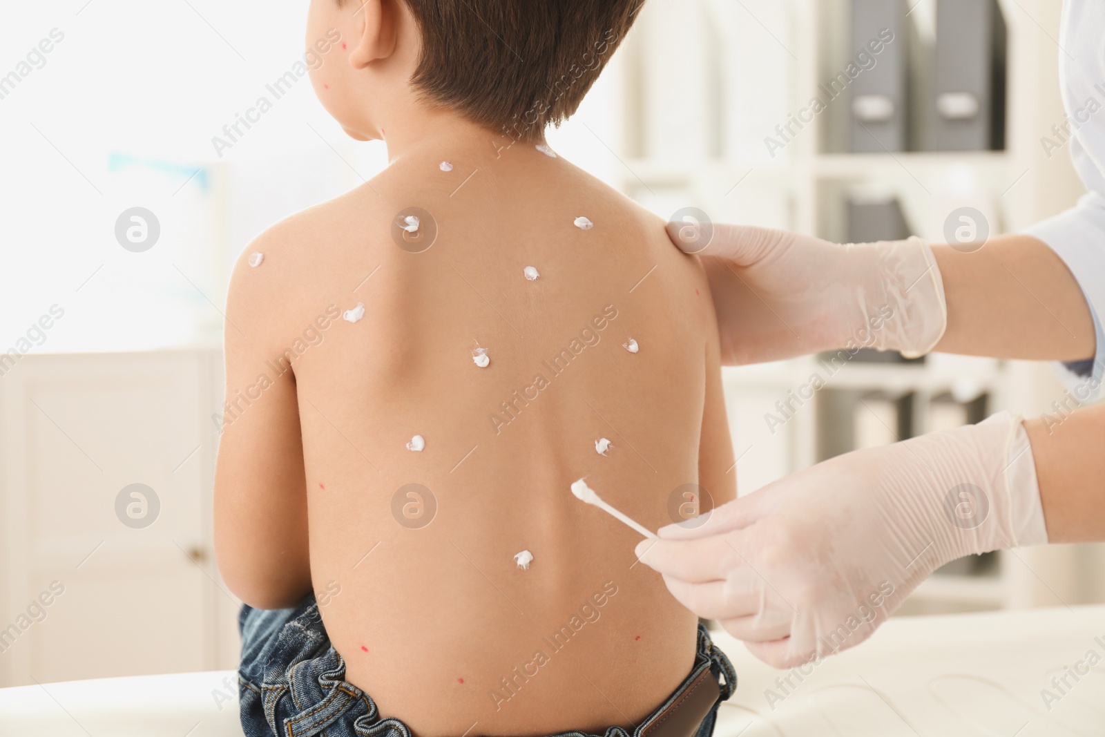 Photo of Doctor applying cream onto skin of little boy with chickenpox in clinic. Varicella zoster virus