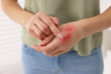 Photo of Woman applying healing cream onto burned hand indoors, closeup