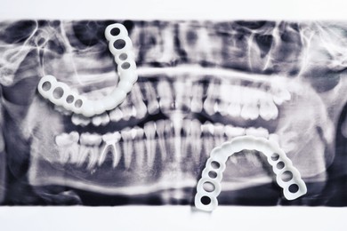 Photo of Mouth guards on dental scan, flat lay. Bite correction