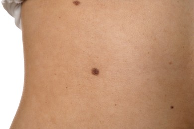 Photo of Closeup of woman's body with birthmarks on white background