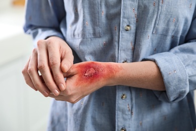 Photo of Woman with burn on her hand against light background, closeup
