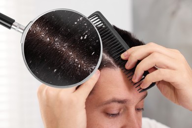 Man suffering from dandruff on blurred background, closeup. View through magnifying glass on hair with flakes