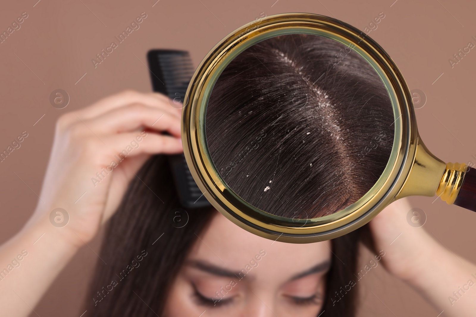 Image of Woman suffering from dandruff on pale brown background, closeup. View through magnifying glass on hair with flakes