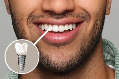Image of Happy man with perfect teeth smiling on grey background, closeup. Illustration of dental implant