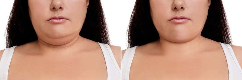 Image of Woman before and after plastic surgery operation on white background, closeup. Double chin problem