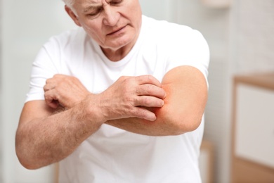 Senior man scratching forearm indoors, closeup. Allergy symptom