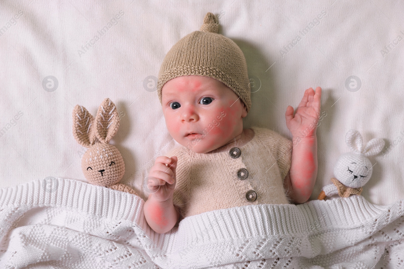 Image of Cute little baby with allergic redness on bed, top view