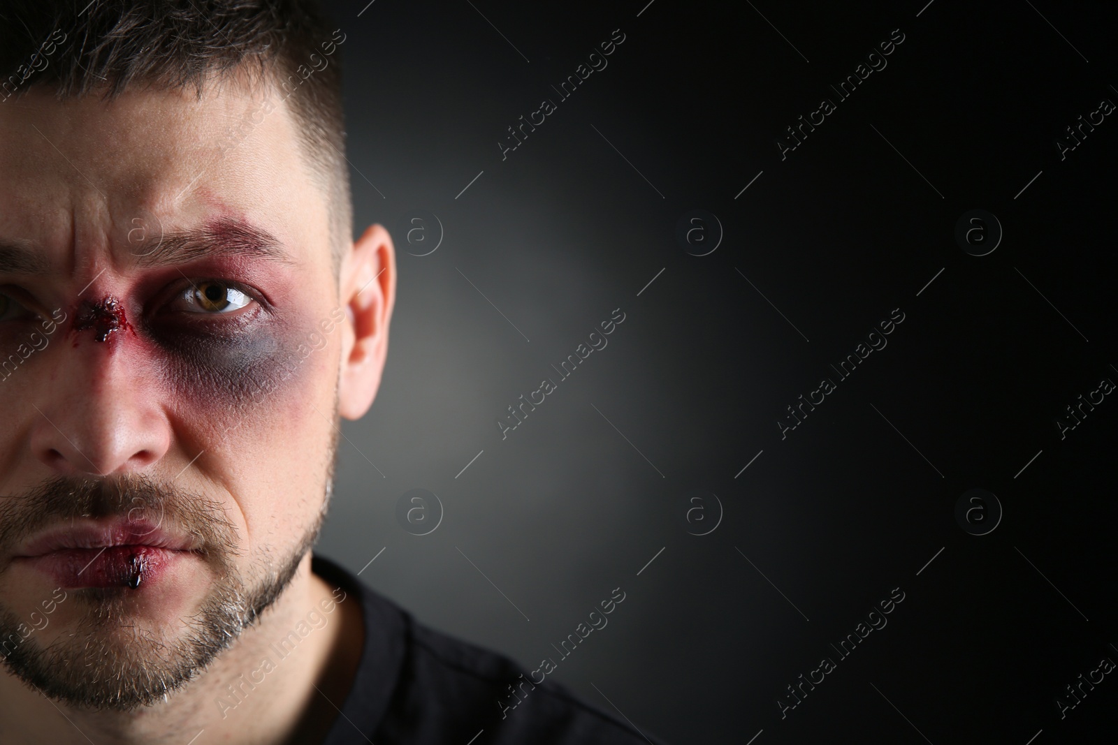 Photo of Closeup view of man with facial injuries on dark background, space for text. Domestic violence victim