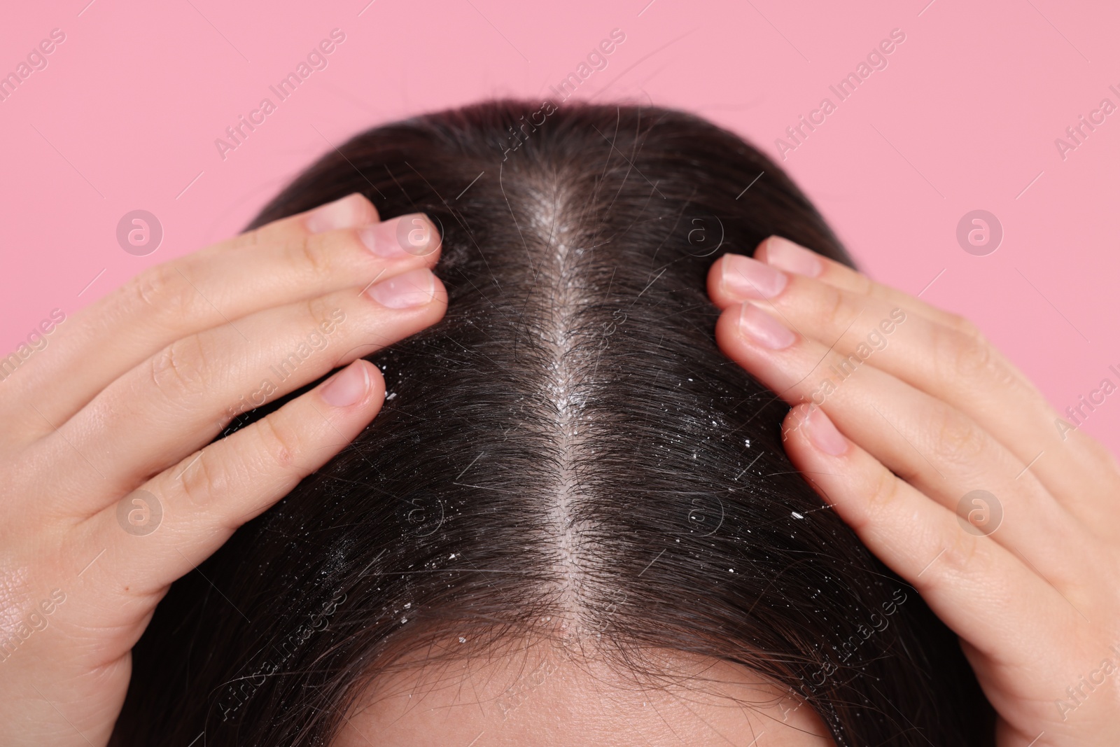 Photo of Woman with dandruff problem on pink background, closeup