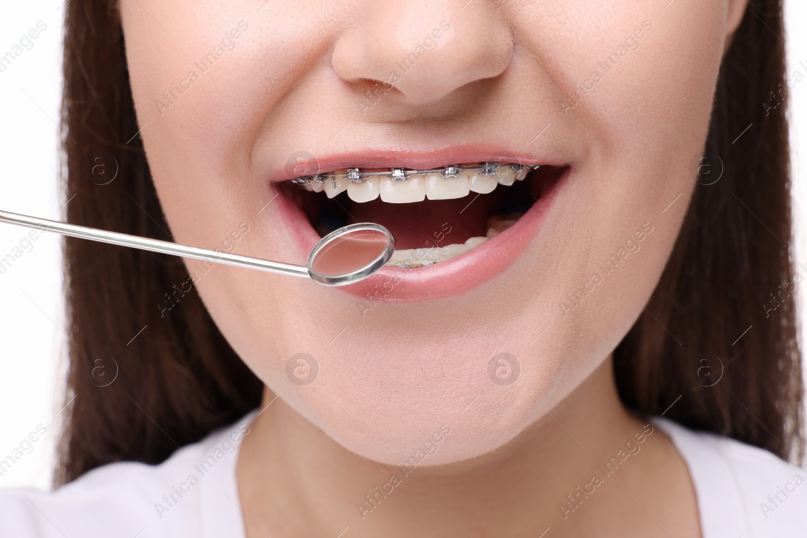 Photo of Examination of woman's teeth with braces using mirror tool, closeup