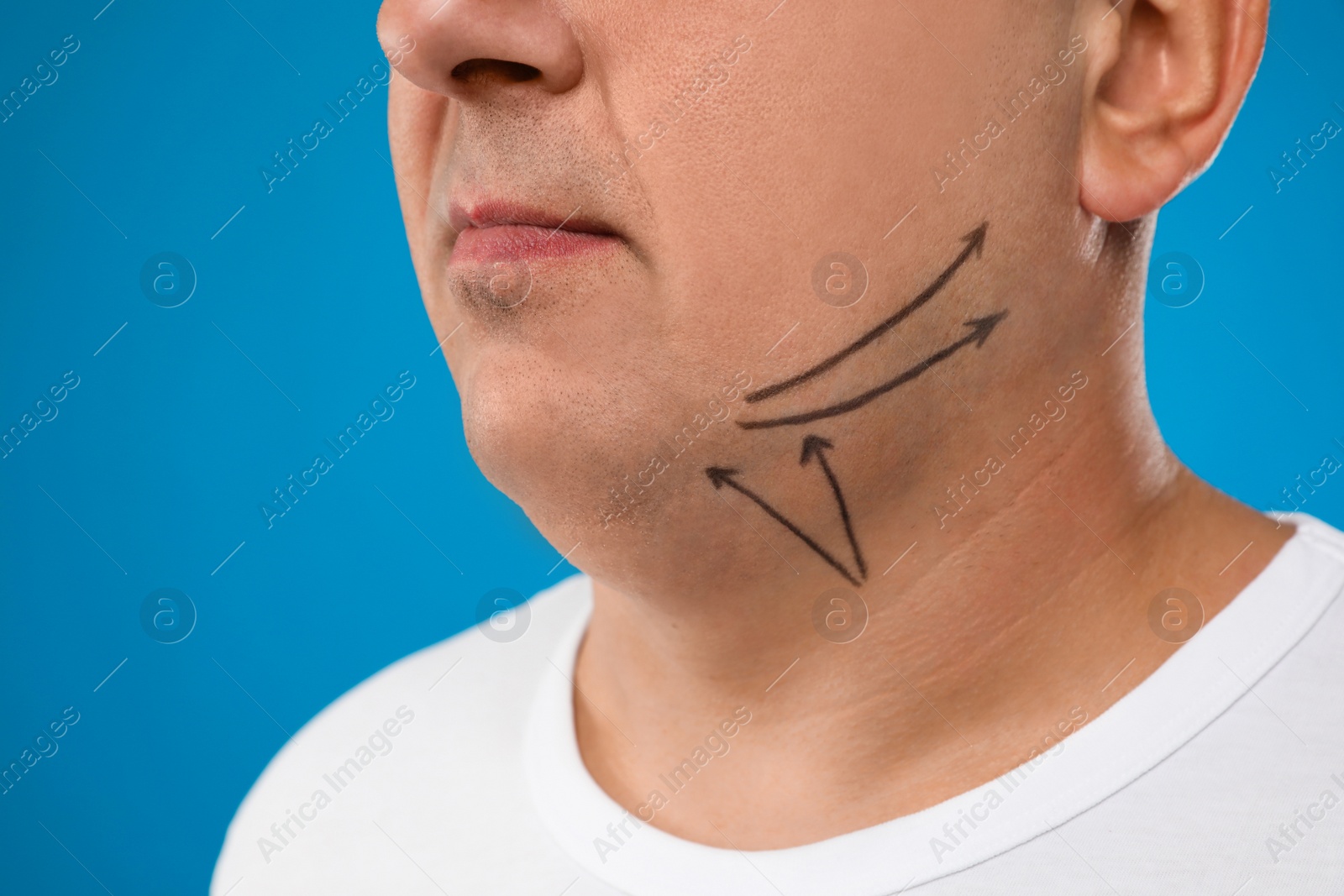 Photo of Mature man with marks on face against blue background, closeup. Double chin removal