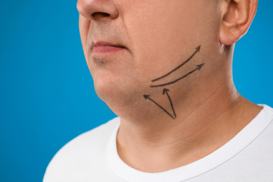 Photo of Mature man with marks on face against blue background, closeup. Double chin removal