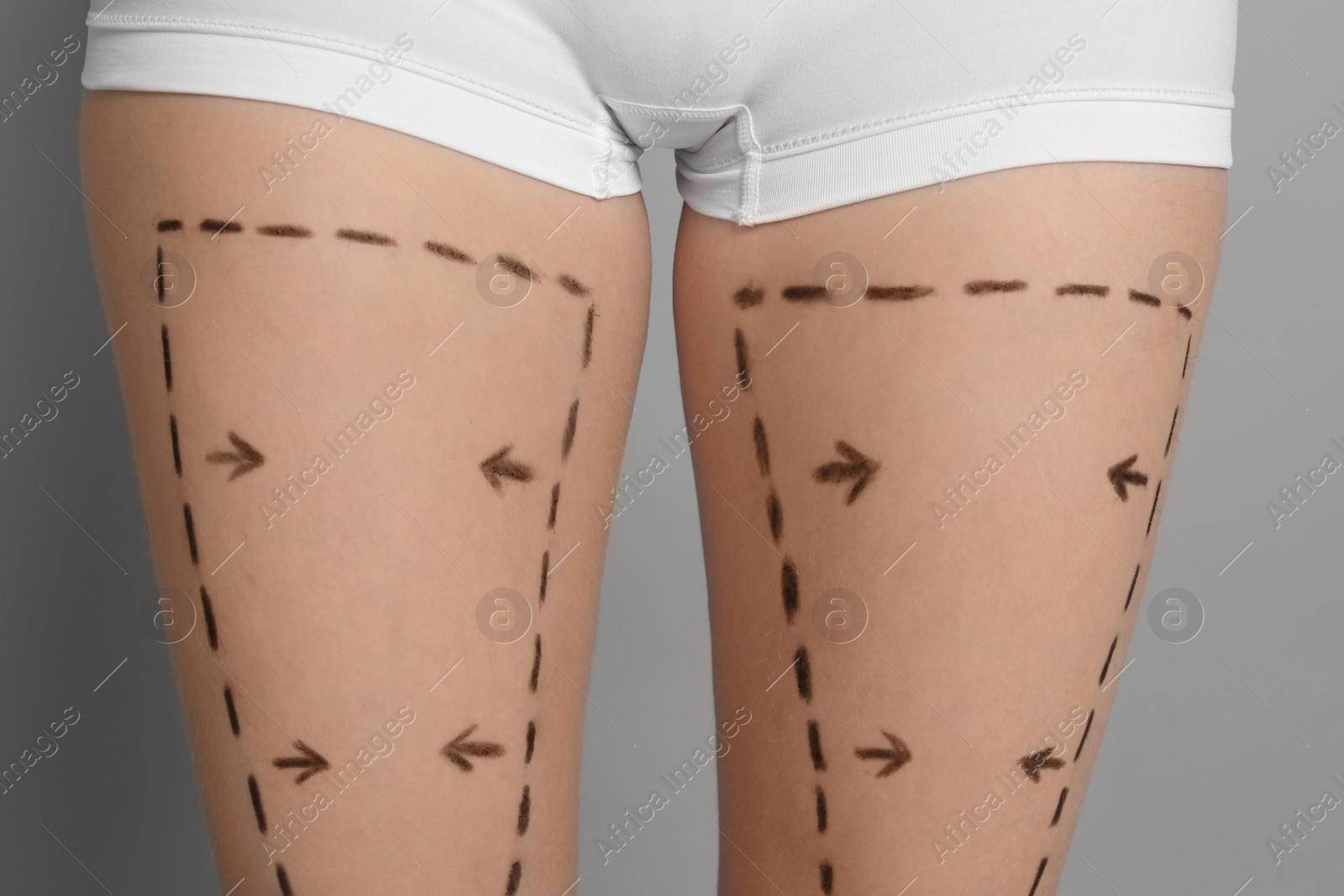 Photo of Young woman with marks on legs for cosmetic surgery operation, closeup