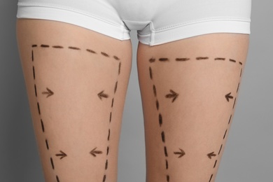 Young woman with marks on legs for cosmetic surgery operation, closeup