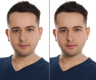 Image of Collage with photos of man before and after lips augmentation