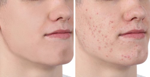 Image of Acne problem. Young man before and after treatment on white background, closeup. Collage of photos